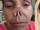 Também no Paquistão, Allah Rakhi foi atacada pelo marido, há 32 anos. Ela tentou fugir das agressões do marido, que a perseguiu e, ao alcançá-la, cortou seu nariz com uma lâmina. Somente este ano Allah passou por uma cirurgia que reconstruiu seu nariz. Na operação, foi usado um pedaço de uma das costelas e pele da testa da mulher para recriar o órgão