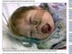 

A menina sofria de síndrome de
Wiedemann Beckwiths, um problema que causa o crescimento acelerado da língua, chegando a sufocá-la às vezes, segundo o site Daily Mail