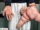 Quando o chinês Lui Hua foi hospitalizado, em 2007, os médicos mediram sua mão gigantesca. O dedão dele media mais de 20 cm e seu dedo indicador bateu em 30 cm. Na primeira cirurgia que ele sofreu, os médicos tiraram 5 kg de carne de sua mão