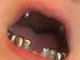 A pequena Savannah White, de apenas quatro anos, foi ao dentista para uma consulta de rotina, mas teve 
uma <a href="http://noticias.r7.com/saude/fotos/menina-de-4-anos-vai-ao-dentista-e-sai-com-os-dentes-de-aco-17012013">desagradável surpresa</a> ao término do procedimento. Seus dentes se 
“transformaram” em aço inoxidável