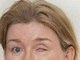 A professora de matemática Jacqueline de Stone, de 42 anos, teve seu olho esquerdo ‘devorado’ depois de usar <a href="http://noticias.r7.com/saude/lentes-de-contato-devoram-olho-de-professora-07022013">lentes de 
contato</a>.&nbsp;Depois de passar por três hospitais durante um mês, ela foi diagnosticada 
com uma infecção ocasionada por um fungo