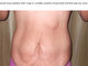 A decisão de engravidar para conseguir fazer a abdominoplastia foi tomada depois que a moça descobriu que a cirurgia estética raramente é realizada em mulheres jovens sem filhos por causa das complicações que o procedimento pode causar durante a gravidez. "Ter um filho para conseguir o corpo que quero foi uma decisão fácil de tomar, mas a gravidez é mais difícil do que pensava"