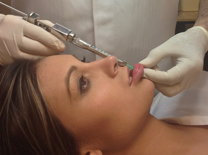 Andressa divulgou no Instagram os detalhes de uma bioplastia para aumentar os lábios. Segundo ela, a intenção era ficar 'bicuda', mas o corpo absorve o preenchimento e ela já teve que refazer 4 vezes.   — Quero uma boca bem carnuda. Não tanto quanto a da Angelina, mas quase