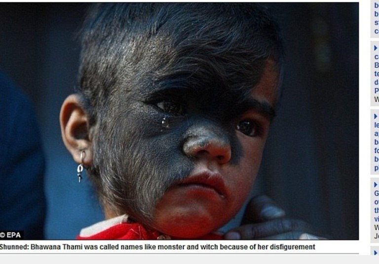 Bhawana Thami, de apenas nove anos, de Dolakha, no Nepal, nasceu com uma condição rara que deixou metade de seu rosto coberto por pelos. Por causa disso, ela foi chamada de bruxa e rejeitada por outras crianças do vilarejo. Veja mais
