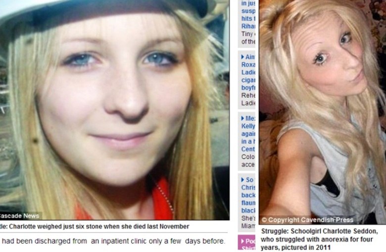 Charlotte Seddon foi mais uma vítima da anorexia. A jovem, de 17 anos de idade, escondeu de seus pais uma anorexia que a fez sofrer há quatro ano. Quando morreu, ela pesava 38 kg. Saiba mais