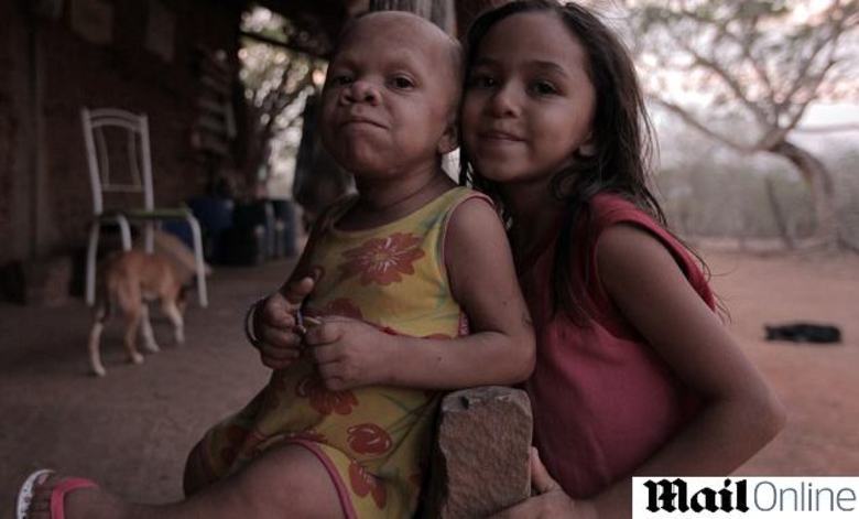 Por enquanto, não se sabe muito sobre a brasileira que
participará do programa. A doença rara que acelera o envelhecimento é uma condição que a Medicina ainda tenta desvendar.  A brasileira é apenas
mais um caso entre muitos que estão aparecendo pelo o mundoGrávida descobre que filhos com “síndrome do envelhecimento” não vão passar dos 12 anos