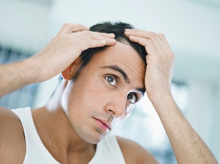 Não muito comum, a alopecia areata — condição autoimune que causa uma reação inflamatória no folículo piloso — leva à perda completa do cabelo em algumas áreas focais ou em todo o couro cabeludo. Ela é provocada quando a pessoa tem uma predisposição genética à doença ou passa por algum estresse emocional extremamente forte.  De acordo com a especialista, essa condição não tem cura. — O paciente que adere ao tratamento à base de medicamentos consegue controlar a queda do cabelo. Mas, a doença pode reaparecer a cada um ou dois anos