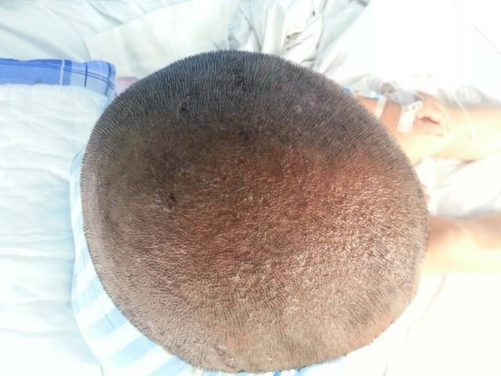 Na quarta-feira (4), os médicos anunciaram que a cirurgia de reconstrução do couro cabelo foi bem-sucedida. Porém, só será possível avaliar como ficarão seus futuros cabelos dentro de um mês