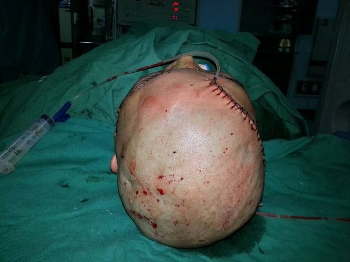 Como estava com os cabelos molhados, ela contou que preferiu não colocar um chapéu protetor. Além dos cabelos e do couro cabeludo, ela teve as orelhas, o pescoço e sobrancelhas puxadas pela máquina