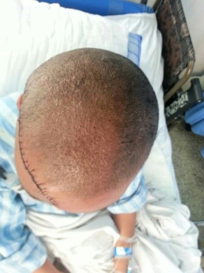 O médico ainda explicou que o couro cabeludo foi recolocado, pois “estava em uma peça inteira”. A operação durou 20 horas e foi “muito difícil”