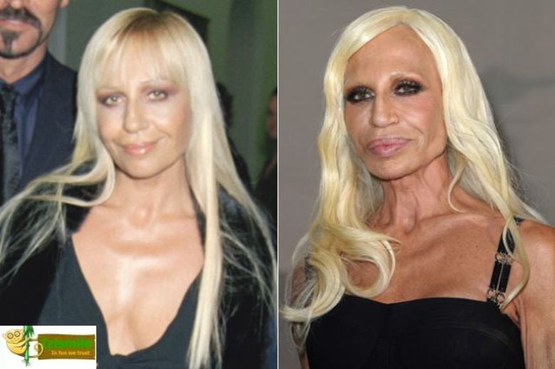 Só juntar uma plástica ruim e uma bulimiazinha e você fica assim, linda!Ou não, né?