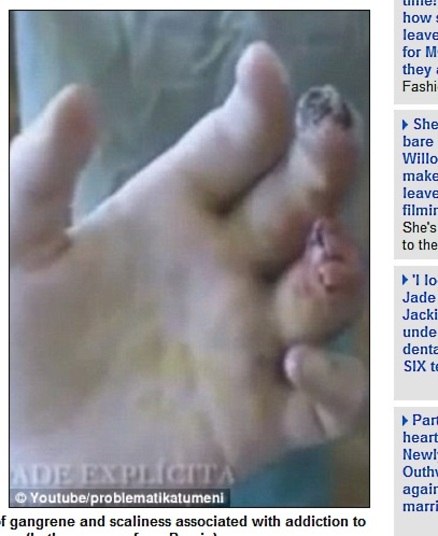 Popular na Rússia e três vezes mais barata que a heroína, o Krokodil é
uma droga caseira feita a partir de uma mistura de codeína, gasolina ou óleo de
fritura, diluentes de tintas, ácido clorídrico, iodo e fósforo vermelho. Ela
pode ser injetada em qualquer parte do corpo, desde os pés até a testa