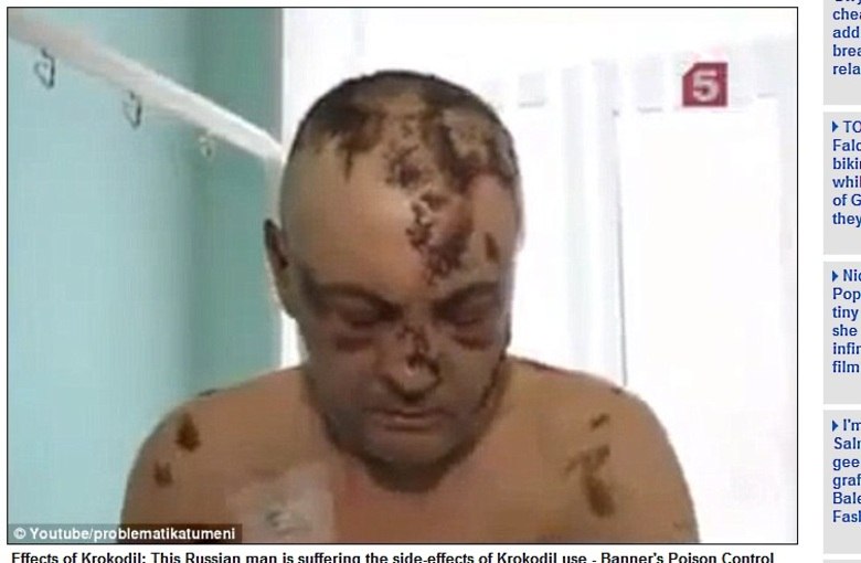 

Uma
nova droga chamada Krokodil tem causado terror na população do Estado do Arizona, nos Estados Unidos. Ela tem o terrível efeito de “comer a carne” dos
usuários. Inflamável, o produto deixa a pele dos viciados como a de um réptil. O medo da população local é que isso se torne uma epidemia. As informações são do site Daily MailEpidemia mundial: crack e metanfetamina destroem corpo e fazem usuário virar zumbi