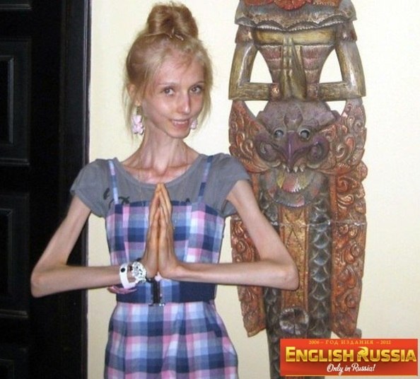 Segundo o endocrinologista da Unifesp João César de Castro Soares de cada 10 casos, 9 são de meninas e 1 de menino.—<br /> Existem sites que fazem apologia à anorexia. Já internei uma menina de<br />12 anos, com anorexia, obcecada por emagrecer desde os nove anos e que<br />aprendeu a maioria dos comportamentos que a levou à doença pela<br />internet. É preciso cuidado e atenção