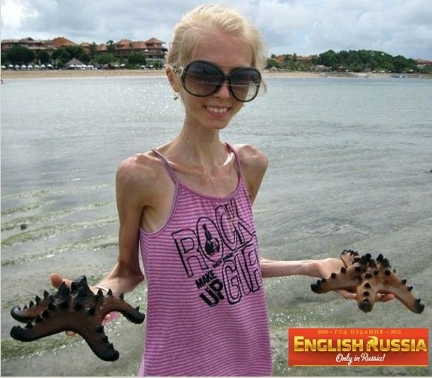 

Aos 20 anos de idade, a russa Kseniya Bubenko é mais uma adolescente
que sofre de anorexia. 

De acordo com o jornal russo English Russia, a jovem começou
a fazer uma dieta chamada de “pobeda”, que significa vitória e, perdeu muito peso. Hoje, sua aparência física é assustadora

