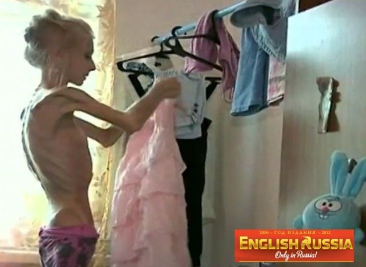 O pensamento comum de quem sofre anorexia é o de que quanto mais peso perder, melhor será