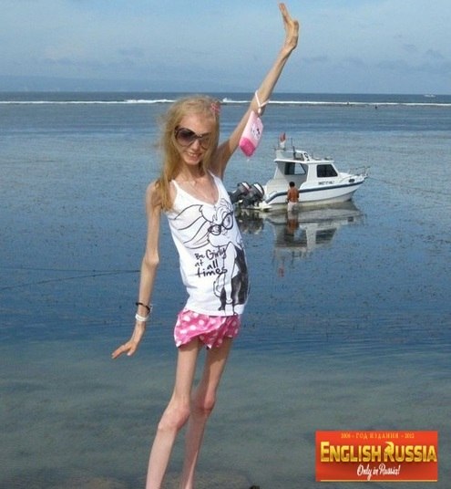  Psiquiatras, nutricionistas, endocrinologistas e terapeutas dão o 
suporte adequado para diminuir os quadros associados à doença: 
depressão, distorção da imagem e desnutrição