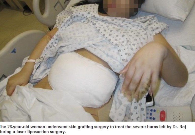 Ao ouvir uma segunda opinião médica, a paciente recebeu a notícia de
que as marcas na barriga eram queimaduras de terceiro grau.
Para contornar a situação, ela precisou ser submetida a uma cirurgia de enxerto
de pele.Raj está sendo processado e, segundo o site Daily News, preferiu não comentar o caso