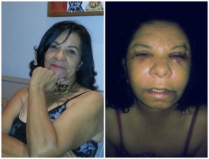 Conhecida como “Rainha dos Caminhoneiros” em Cascavel, no
Parará, a apresentadora de TV, Edileuza Fabrini, de 65 anos, vive hoje um
pesadelo: ter que conviver com seu rosto deformado após erro médico em uma
cirurgia plástica. Emocionada, ela conta que depois da operação malsucedida,
sua vida se transformou completamente. Além de problemas de saúde, ela foi
obrigada a largar o comando do programa de TV que fazia “há 32 anos
consecutivos”, como ela mesma faz questão de falar.   