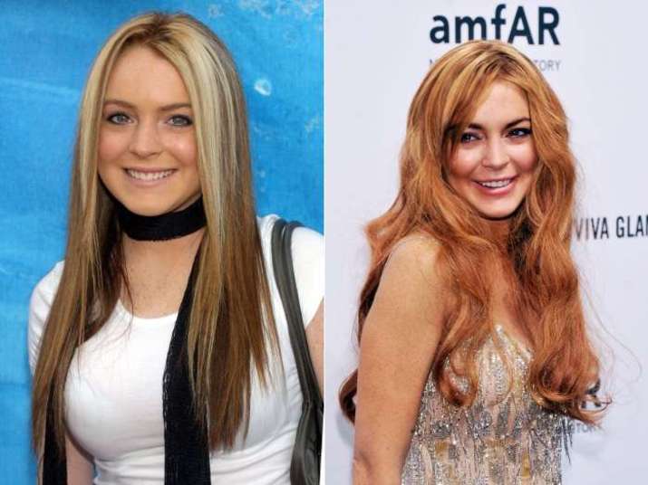 Lindsay Lohan começou a aplicar botox desde cedo. A dermatologista Flávia explicou que não há uma idade mínima para começar, tudo depende da qualidade da sua pele. — Não existe uma idade mínima. Tem mulher que com 25 já pode começar a aplicar, outras só vão precisar em idade avançada. A toxina pode ser usada como prevenção