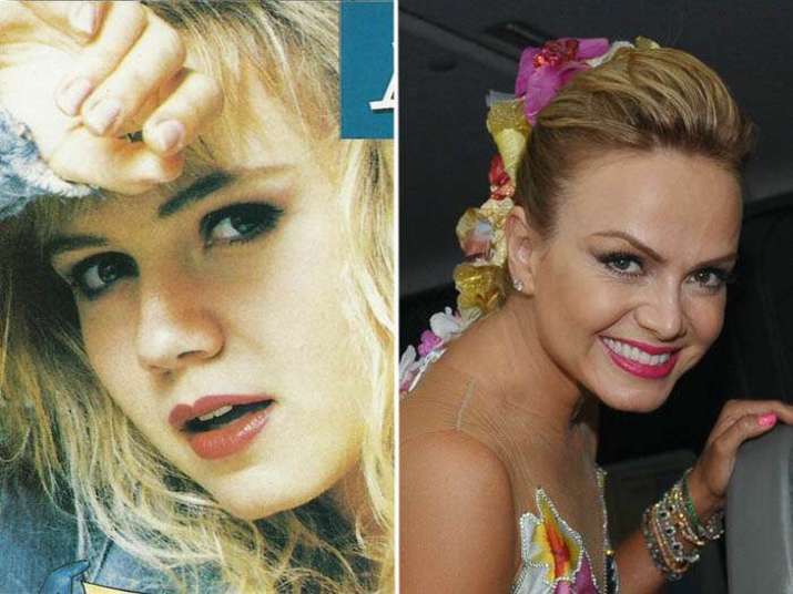 A apresentadora Eliana também é uma das famosas que aposta no botox. Flávia Addor explicou quais são os pontos de aplicação mais comuns. — Os pontos clássicos de aplicação são os do seio superior da face. Entre os olhos, nos pés de galinha e nas linhas de expressão da testa