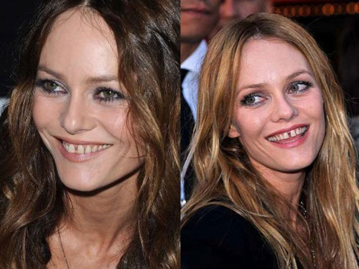 A atriz e cantora francesa Vanessa Paradis precisa ir a um dentista com urgência. A artista também tem os dentes da frente separados, além de um pouco amarelados