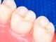 A retração
gengival devido à idade, escovação inadequada, inflamação gengival e, até dentes tortos, são
algumas das causas da sensibilidadeAparelhos ortodônticos garantem o sorriso mais bonito