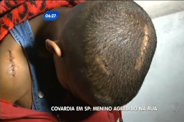 Um menino de 11 anos foi agredido com um facão no Grajaú, zona sul de São Paulo, na última terça-feira (17). A criança estava empinando pipa quando dois desconhecidos se aproximaram e o atacaram. Um suspeito já foi preso