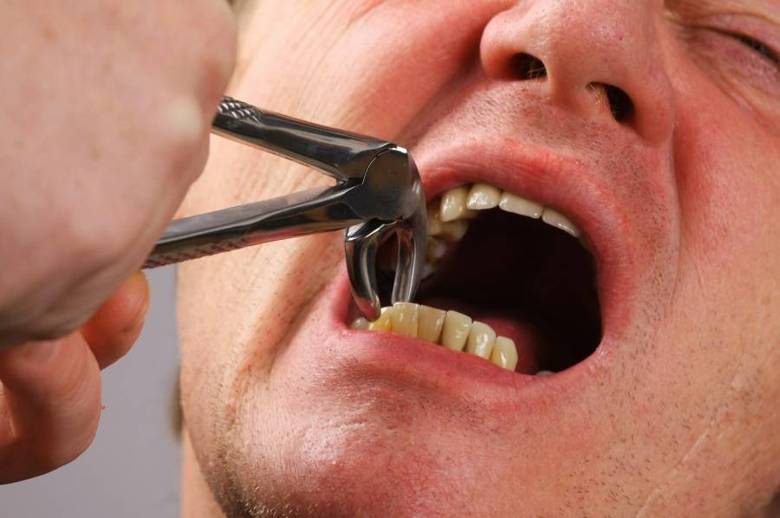 Com as extrações dos dentes, os espaços internos da
boca diminuem e poderá provocar distúrbios nas áreas respiratórias, digestiva e
muitas vezes, até nas estruturais.— Quando se movimentam
demasiadamente os dentes, podem surgir desde problemas de coluna e postura até
visuais, como a miopia