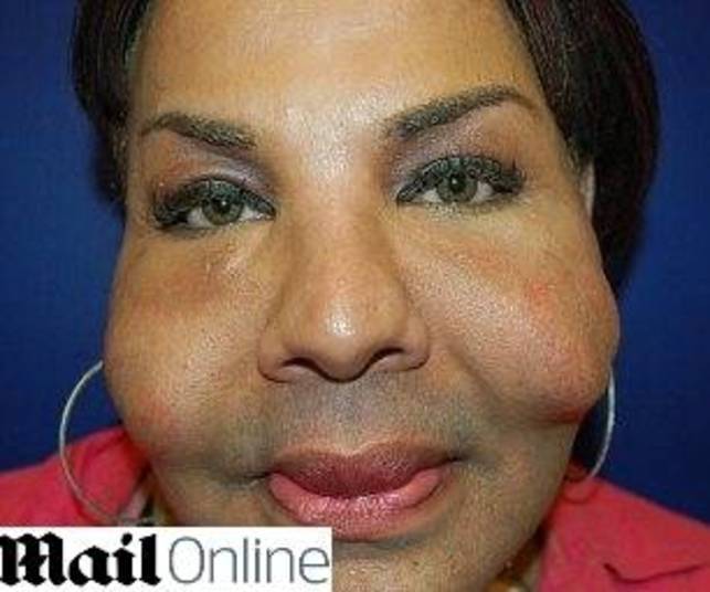 Em entrevista ao jornal britânico Daily Mail, ela contou que, na época, não tinha dinheiro para recorrer a um cirurgião plástico licenciado, mas que não imaginava que o falso médico fosse aplicar cimento em seu rosto