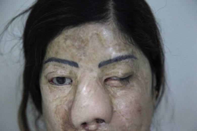 

O médico cirurgião Asim Shahmalak gastou de seu próprio
bolso cerca de R$ 150 mil para reconstruir o rosto de seis vítimas de ataque
com ácido. As mulheres são do PaquistãoApós queimaduras, adolescente passa por inúmeros enxertos