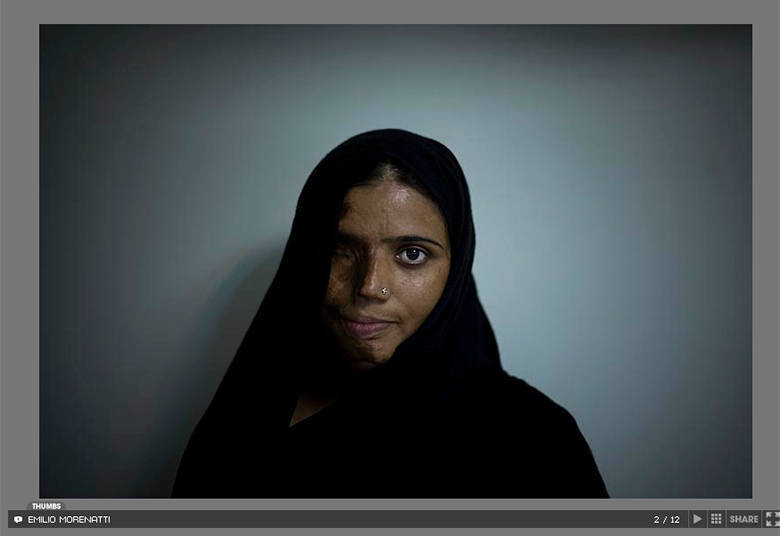 Munira Assef foi queimada com ácido aos 18 anos, por um rapaz com quem não quis se casar