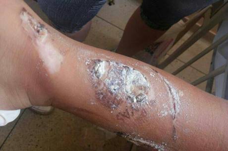 Produto químico causou feridas na pele da criança
