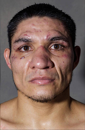 A foto depois da luta não foi muito boa, pelo menos para o lutador. Vários cortes no rosto A foto depois da luta não foi muito boa, pelo menos para o lutador. Vários cortes no rosto