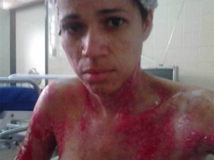 A moça se lembra dos momentos de terror que viveu.— Os meus olhos foram atingidos, os meus braços e uma das minhas pernas. Eu cheguei a gritar por socorro, porque teve um momento que eu não conseguia ver mais nada”, lembra. Veja na reportagem!
