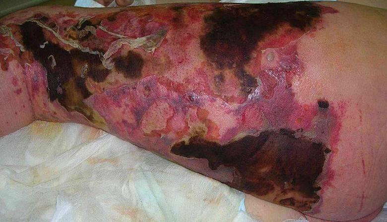 A doença destrói pele, gordura e músculos em um curto período de tempo. As vítimas, em geral, são as que têm baixa imunidade