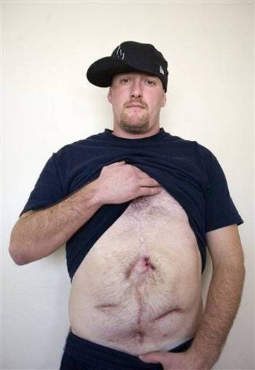 Dusty Collins, 27, mostra as cicatrizes deixadas pela bactéria comedora de carne, em 2008. Ele acredita que contraiu a doença em um acidente de carro