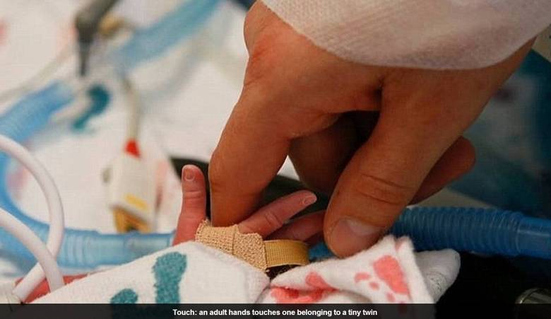 



Segundo a publicação, as pequenas compartilharam o mesmo saco
amniótico e placenta, algo considerado completamente raro pelos médicos 

