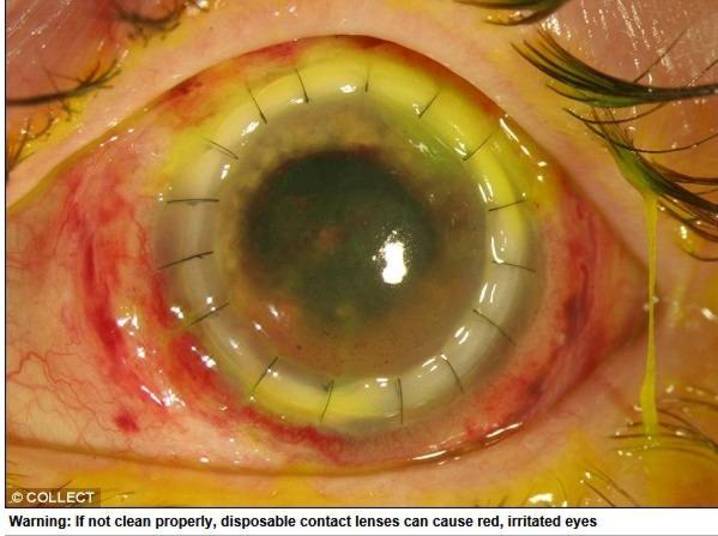 Uma
estudante de Taiwan ficou cega após utilizar um par de lentes de contato
descartáveis por seis meses consecutivos. Por causa da falta de limpeza, uma
ameba “comeu” os olhos de Lian Kao. As informações são do Daily Mail