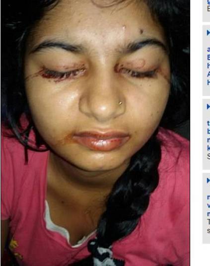Após a primeira aparição do sangramento, Preeti teve um
intervalo de cerca de 12 meses até ter um segundo episódio que, segundo ela, foi
muito pior.
― Sei que meus olhos vão começar a sangrar porque eles
ficam muito doloridos. Assim que o sangue sai a pressão alivia e a dor passa