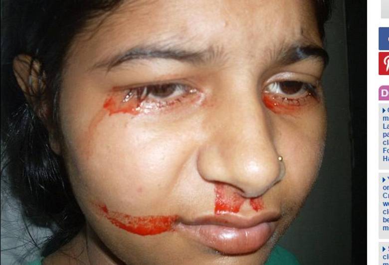 Preeti e sua família foram pegos de surpresa quando, em
2009, a jovem indiana começou a chorar e suar sangue. Seu pai, Manoj Gupta, de
35 anos, a levou ao hospital pensando que sua filha sofria com uma simples
infecção, porém nenhum médico foi capaz de dizer o que havia de errado com
Preeti
― Estamos desesperados para ela viver uma vida normal. Não
temos ideia o que tem de errado com ela. Nós só queremos um médico para curá-la