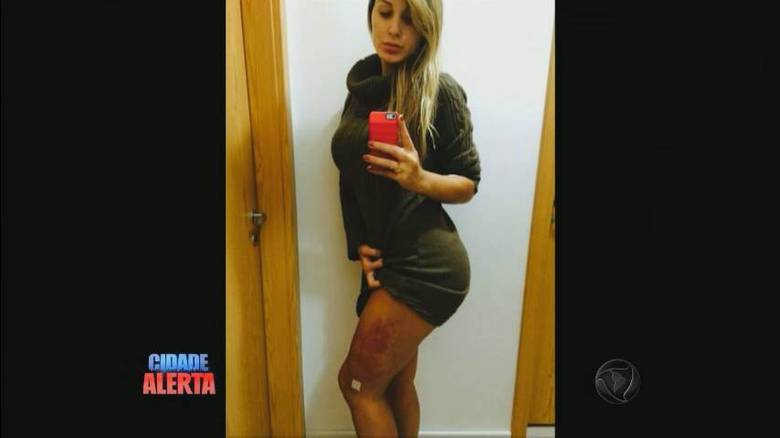 Andressa já passou por duas cirurgias e deverá passar por mais um procedimento na tentativa de conter a infecção  + Assista ao vídeo! 