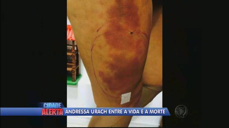 Andressa fez uma aplicação de hidrogel nas pernas no último mês de julho e começou a sentir dores na região. No último domingo (30), ela sentiu novamente estas fortes dores e teve que passar por procedimentos para a drenagem do hidrogel. A situação se complicou e Andressa acabou tendo uma infecção + Assista ao vídeo! 