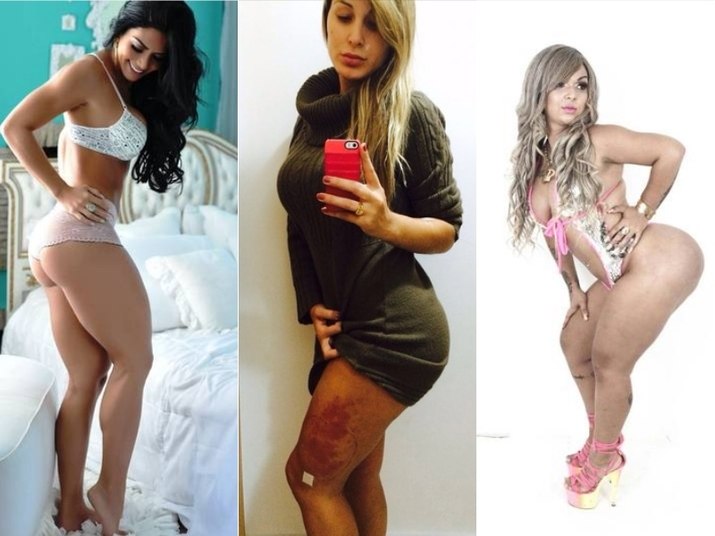 As famosas fazem mesmo tudo em nome da beleza e Andressa Urach não é a única que apostou em aplicações de produtos para aumentar os atributos. A ex-vice miss Bumbum Graciella Carvalho e a funkeira Maysa Abusada também confessaram ter passado por procedimentos parecidos para deixar as curvas ainda maiores. No entanto, elas têm posturas diferentes diante do quadro de saúde da ex-peoa. Entenda melhor nas imagens a seguir!Assista: Antes de complicações, Andressa Urach temia rejeição de hidrogel*Colaborou, Rebeca Tosta, estagiária do R7