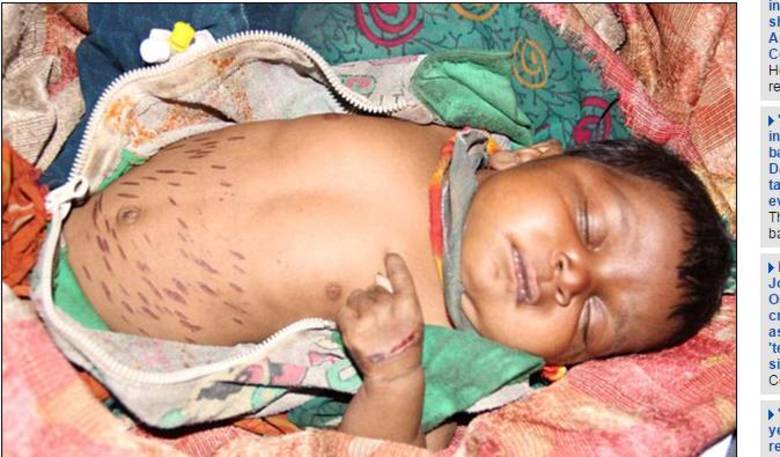Shivani Seheryiya, de dois meses, foi marcada 40 vezes com uma faca quente por um curandeiro de Sheopur, na Ãndia, que afirmava que o â€œprocedimentoâ€ iria curar uma pneumonia que a crianÃ§a havia contraÃ­do. Apesar de o ritual ser uma prÃ¡tica tradicional do paÃ­s, Shivani acabou piorando e teve que ser levada Ã s pressas para ao hospital