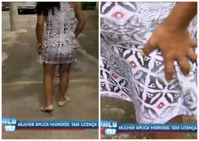 Mais um caso de aplicao de hidrogel terminou mal no Rio de Janeiro. Uma mulher que prefere no se identificar  a mais recente vtima da substncia usada para preencher e dar volume em diferentes partes do corpo. Aps passar pelo procedimento, ela teve reao ao produto e foi parar na emergncia de um hospital na Baixada Fluminense. Assista ao vdeo