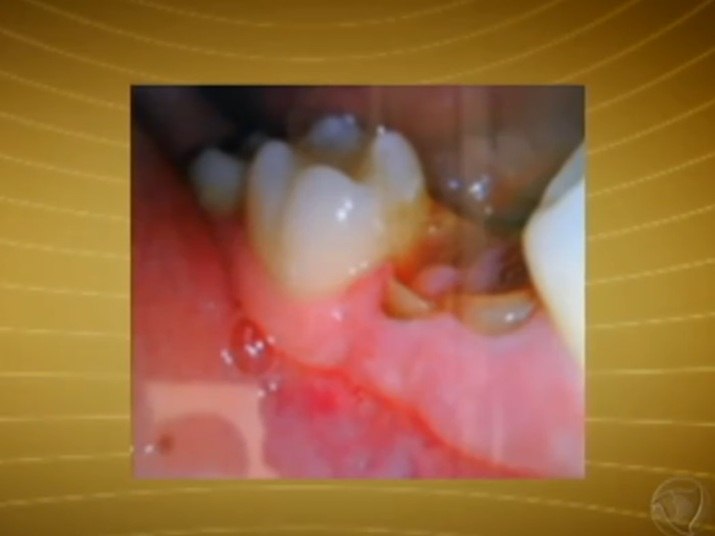 Endocardite é uma infecção no endocárdio, revestimento interno do coração. Normalmente a doença acontece quando uma bactéria ou germes de outra parte do corpo, como os da boca, se espalham pelo sistema sanguíneo se ligando a áreas afetadas do coração. A endocardite é incomum em pessoas com coração saudávelNo R7 Play você pode assistir ao Fala Brasil na
íntegra! Clique e experimente de graça!+ Uma simples cárie pode matar; veja 