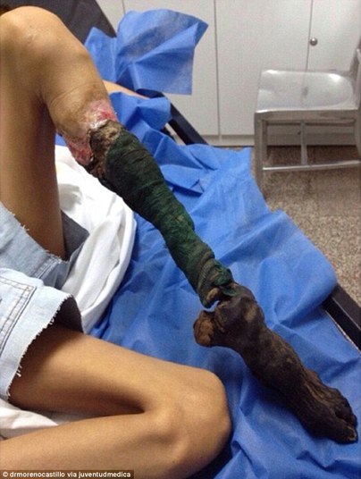 A perna teve que ser amputada para evitar que a infecção se espalhasse pelo corpo 