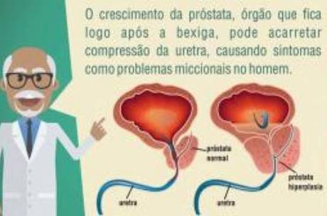 Sociedade Brasileira de Urologia faz um alerta à população masculina sobre o aumento da próstata