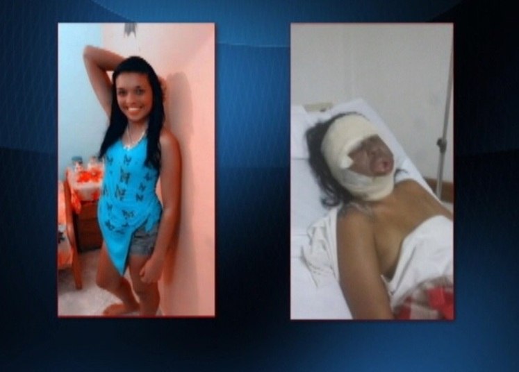 Aline Cristiane dos Reis, de 24 anos, teve queimaduras de 2º grau pelo corpo e ficou internada em estado grave